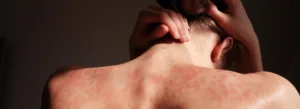 Uma pessoa de costas, com as mãos na cabeça, exibindo manchas vermelhas e irritadas na pele sob uma luz suave.