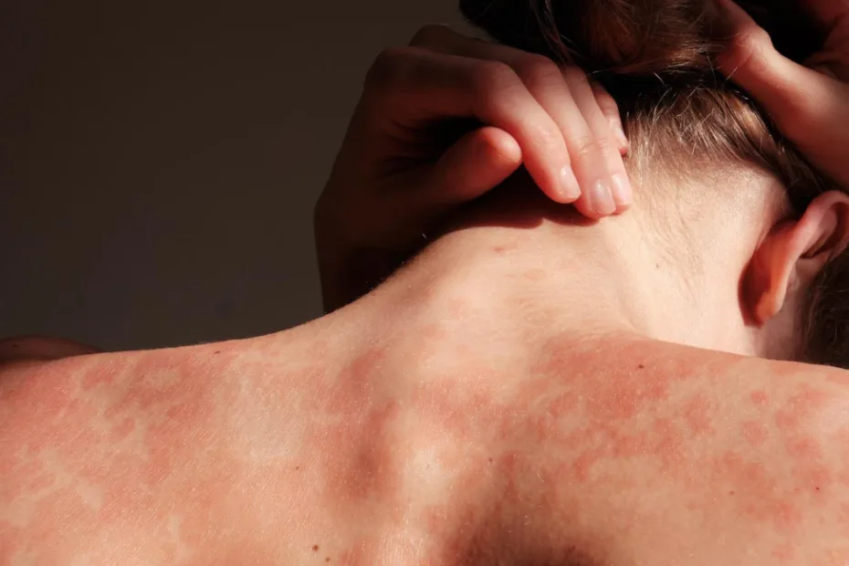 Uma pessoa de costas, com as mãos na cabeça, exibindo manchas vermelhas e irritadas na pele sob uma luz suave.